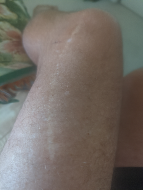 photo of an antereolateral left thigh showing a 22cm long well-healed surgical scar