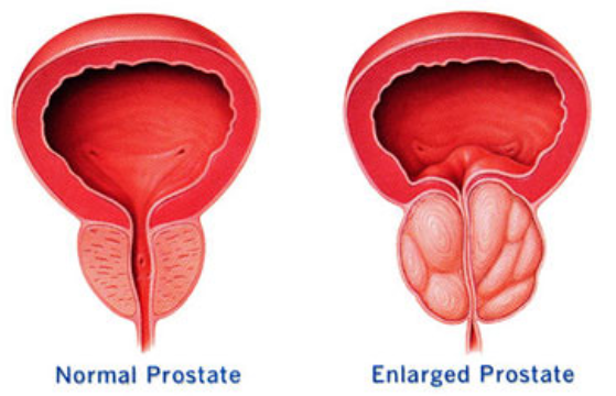 drawing of a bladder, normal prostate, and urethra on the left and the same drawing but with an enlarged prostate on the right